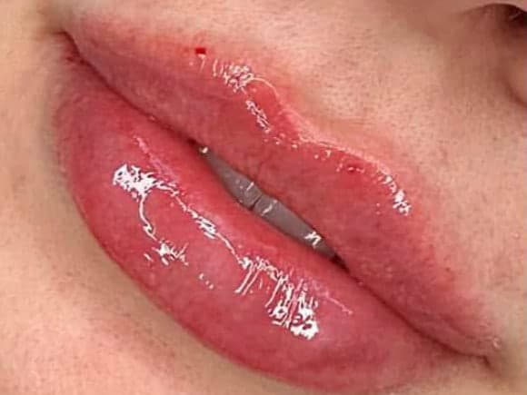 Close detail of lips after a dermal filler appointment
