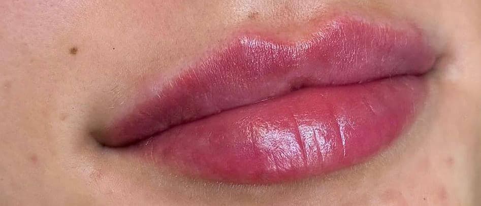 Lips after a dermal filler appointment at Empire Aesthetics