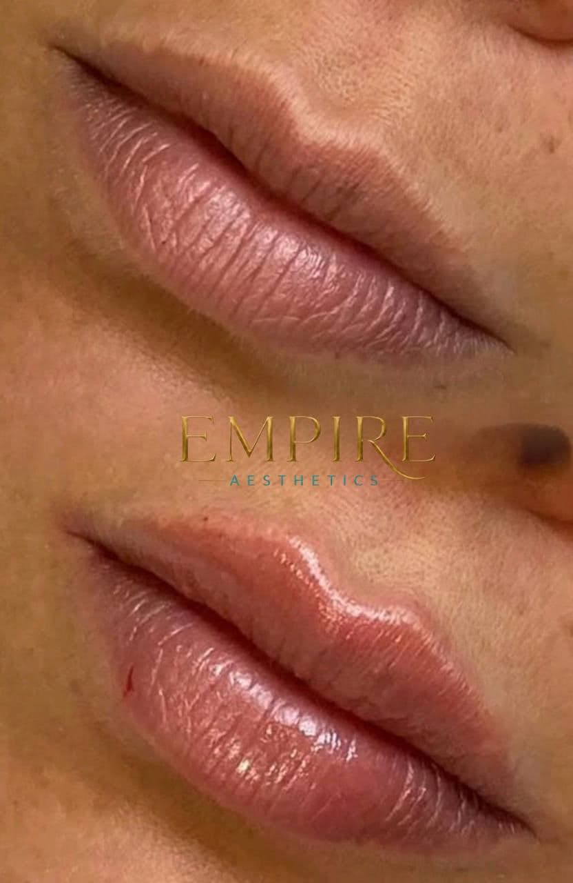 Lip filler before and after at Empire Aesthetics