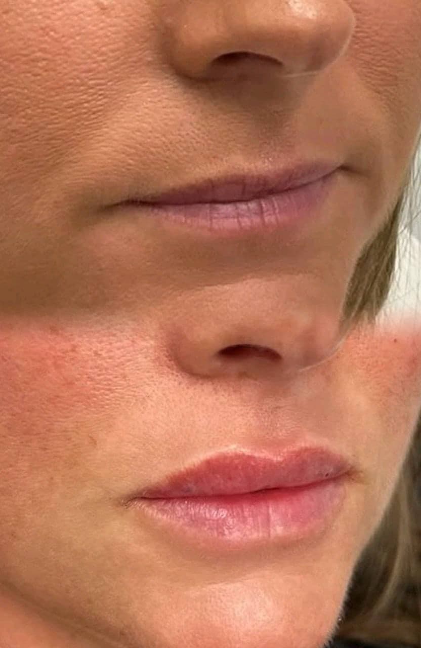 Lip filler before and after, front on, at Empire Aesthetics