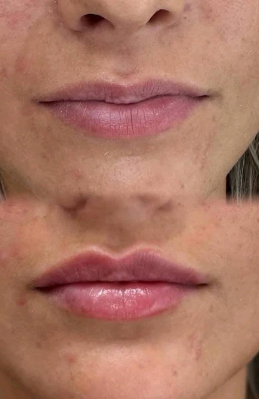 Lip filler before and after, showing the lip line, at Empire Aesthetics