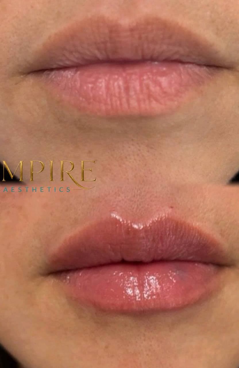 Lip filler before and after, close, at Empire Aesthetics