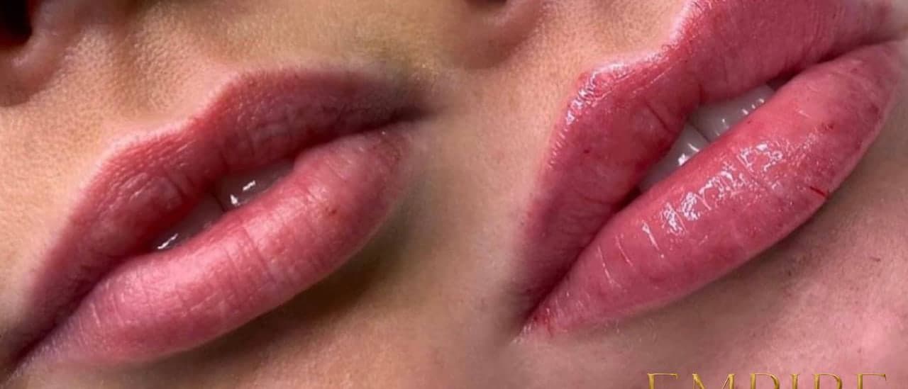 Lip filler before and after, side by side, at Empire Aesthetics