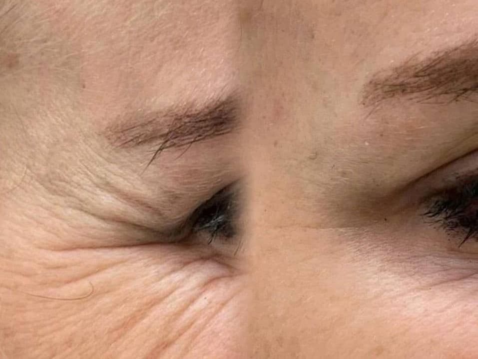 The brow and eye area before and after treatment at Empire Aesthetics